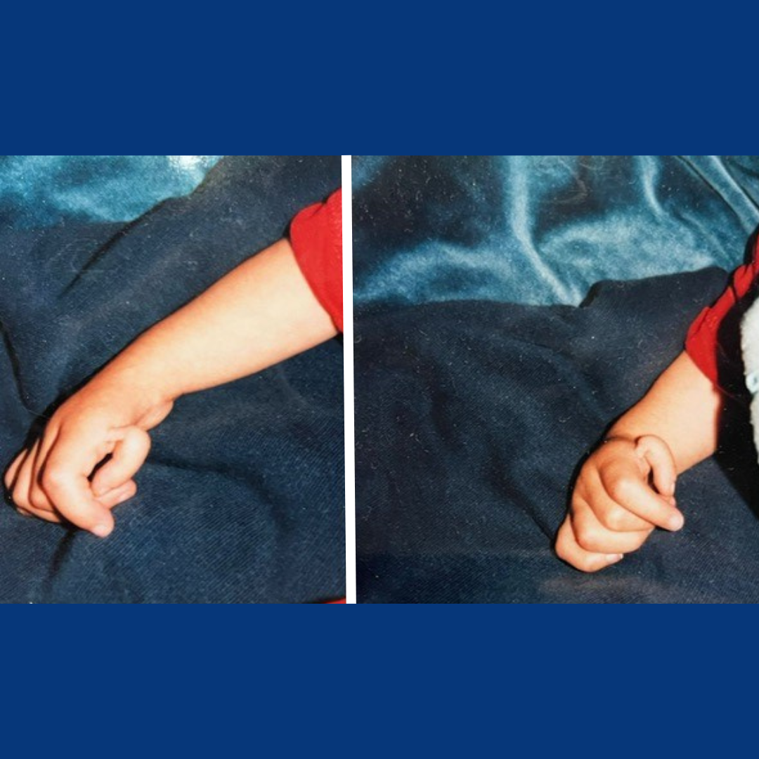 Two images of Chloe's thumbs when she was a small child. You can see that there is no bony joint attaching her thumbs to her hands.